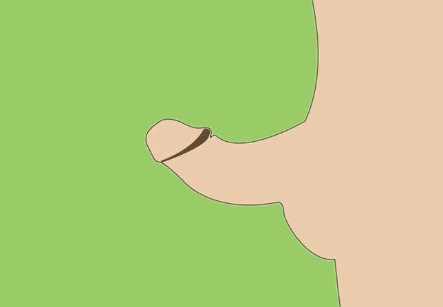 καμπυλότητα του πέους ως ένδειξη για χειρουργική διεύρυνση